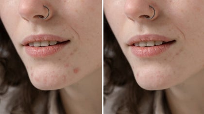 Facial touch up showing blemish fix tool removing red spots in one click