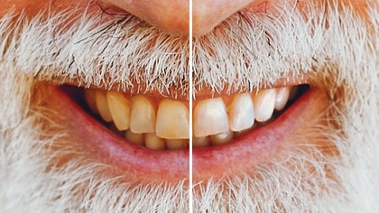 Smile enhanced with touch up tool for brighter, whiter teeth