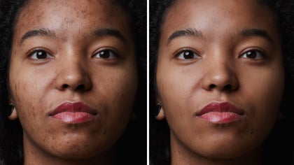 Before and after face touch up using Perfect Skin Tool for even tone and smooth texture